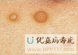 傳染性軟疣能自愈嗎