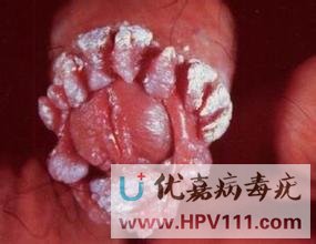 病毒疣什么原因引起