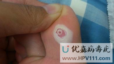 如何區(qū)別跖疣和雞眼