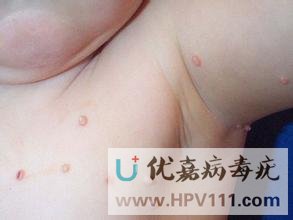 小兒傳染性軟疣圖片