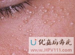 得了病毒疣怎么辦