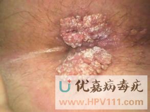 肛周尖銳濕疣癥狀
