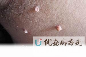 皮贅還是絲狀疣