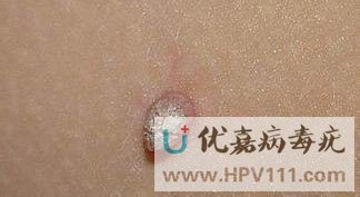 皮贅還是絲狀疣