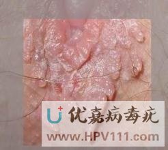 病毒疣是什么引起的