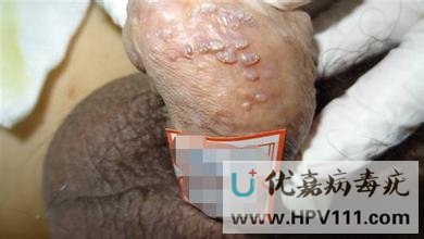 病毒疣傳染嗎