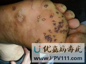 雞眼膏能治跖疣嗎
