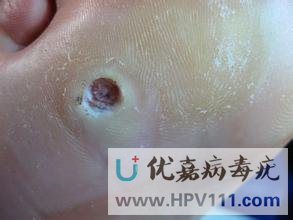雞眼膏能治跖疣嗎