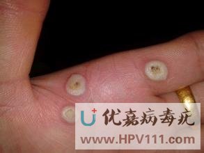 手指長尋常疣圖片