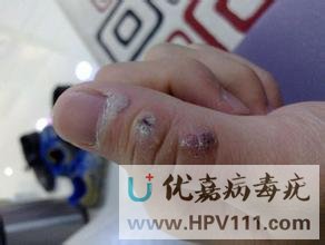 尋常疣冷凍后圖片