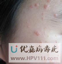 病毒疣圖片什么樣子