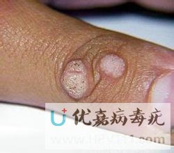 病毒疣圖片什么樣子