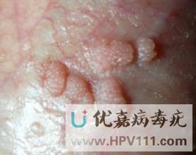 陰囊上有白色小疙瘩是尖銳濕疣嗎