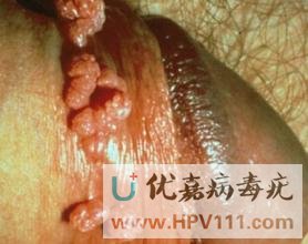 病毒疣的癥狀有哪些
