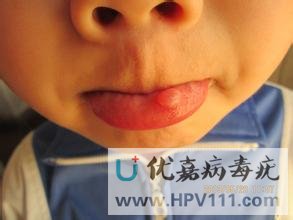 口腔尋常疣圖片