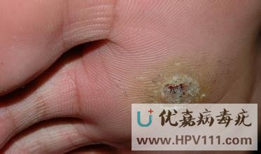 跖疣和雞眼的區別,怎么治療