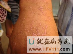 手足病毒疣是什么病