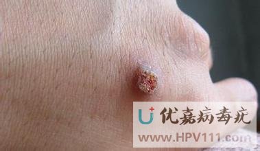 尋常疣的種類及圖片