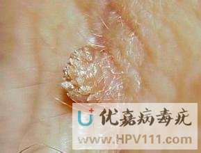 尋常疣的種類及圖片