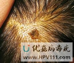 尋常疣的種類及圖片