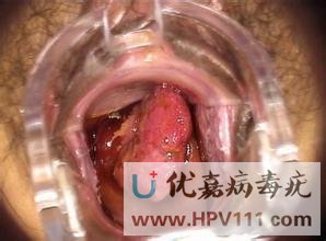 女尖銳濕疣癥狀圖片有嗎