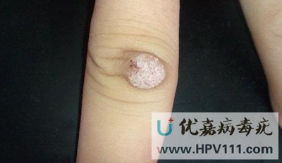 尋常疣的特點是哪些