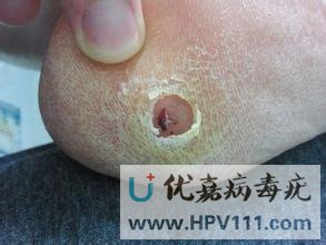 尋常疣的特點是哪些