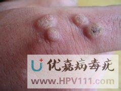 手上長病毒疣是怎么回事