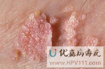 有病毒疣該怎樣治療