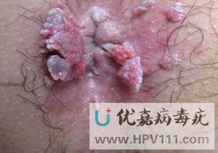 病毒疣會(huì)傳染嗎