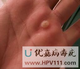 尋常疣疣體是怎樣的