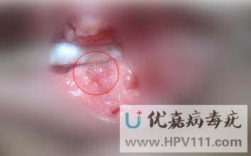 病毒疣早期有什么癥狀