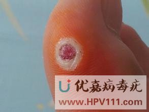 跖疣和雞眼,你分得清嗎