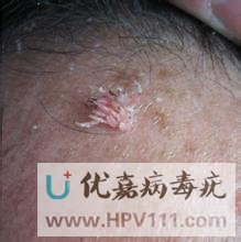 病毒疣初期癥狀圖