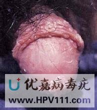 大連治療病毒疣的醫院