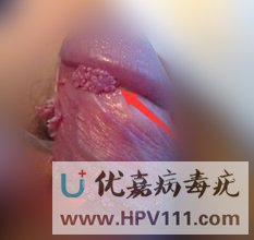 大連治療病毒疣的醫院