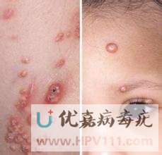 眼部傳染性軟疣癥狀圖片