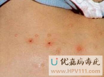 眼部傳染性軟疣癥狀圖片