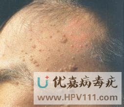 怎樣科學(xué)預(yù)防扁平疣