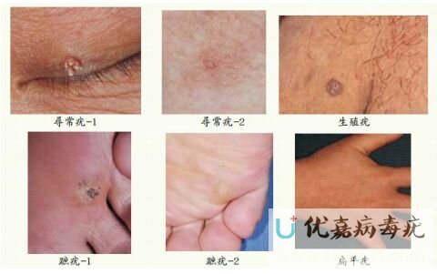 病毒疣的傳染性極強