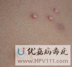病毒疣的傳染性極強