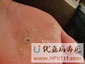 腳底長病毒疣怎么治療