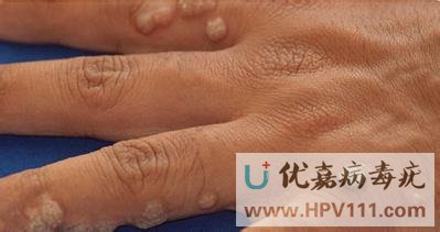 尋常疣產生原因是什么