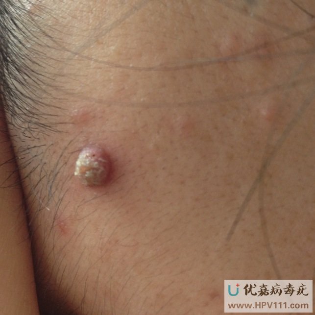 尋常疣產生原因是什么