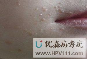 誤將扁平疣當青春痘
