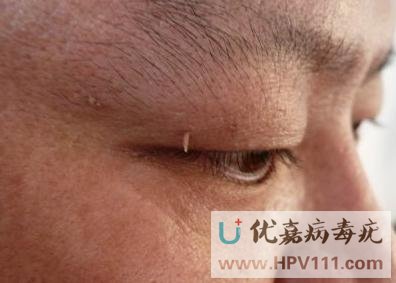 絲狀疣hiv有什么關系