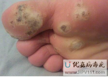 腳底長跖疣快好了的圖片