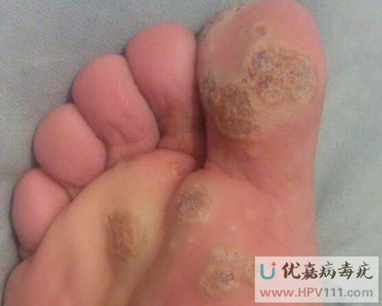 跖疣好轉的癥狀表現是什么