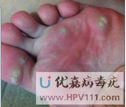 雞眼與跖疣有何區別,該怎樣治療