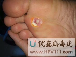 雞眼與跖疣有何區別,該怎樣治療